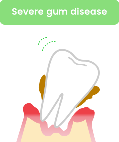 severe gum disease
